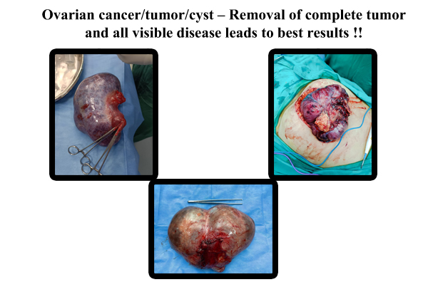 Ovarian Cancer Surgeon